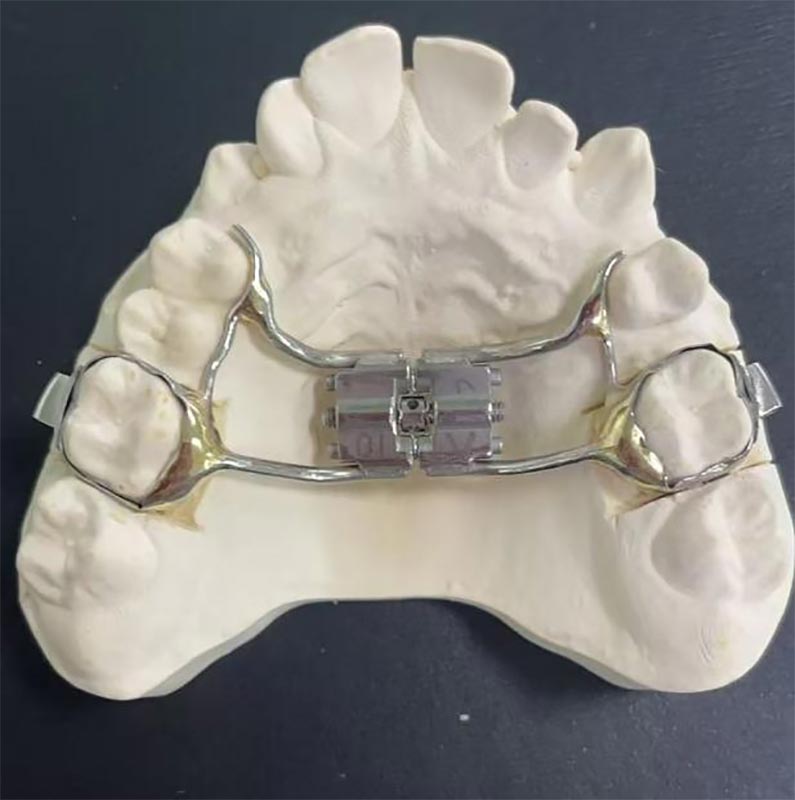 Apakah Expander Maxillary Rapid (RME)?