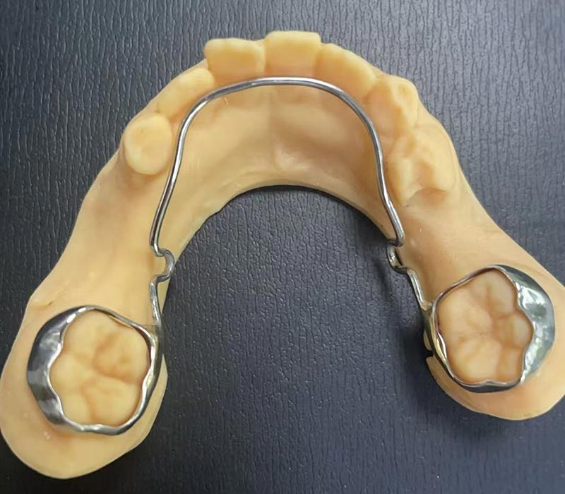 Penahan Gerbang Lingual Mandibular