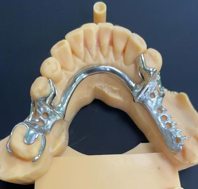 Kelebihan Rangka Kerja Cobalt-Kromium (Rangka Kerja Co Cr)