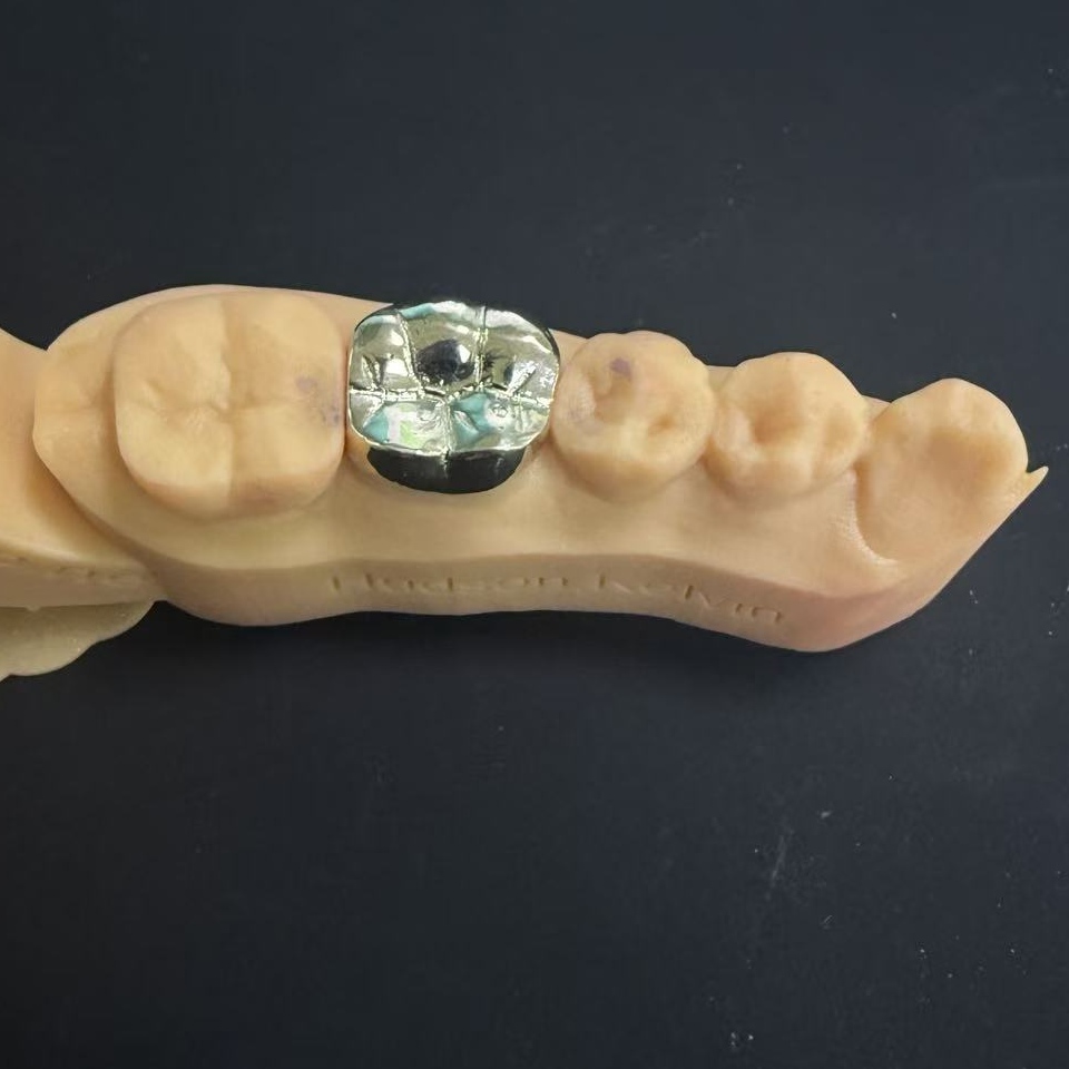 Mahkota Emas: Pilihan Logam Berharga untuk Pemulihan Pergigian Sepanjang Hayat