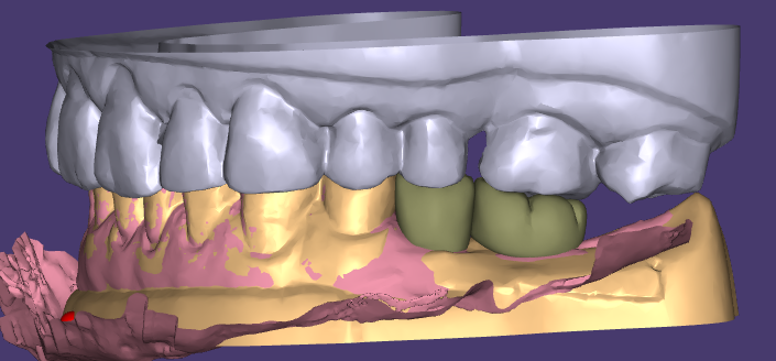 WM Dental Lab's Aesthetic Wax-Up dan Pemulihan Sementara Memenangi pujian Pelanggan Sebulat suara