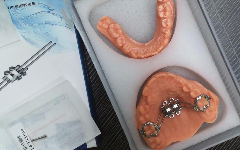 Fahami MSE Skeletal Expansion dengan WM Dental Lab