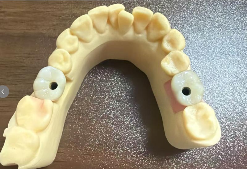 Mengapa Implantasi Gigi Depan Lebih Sukar Daripada Implantasi Gigi Posterior?
