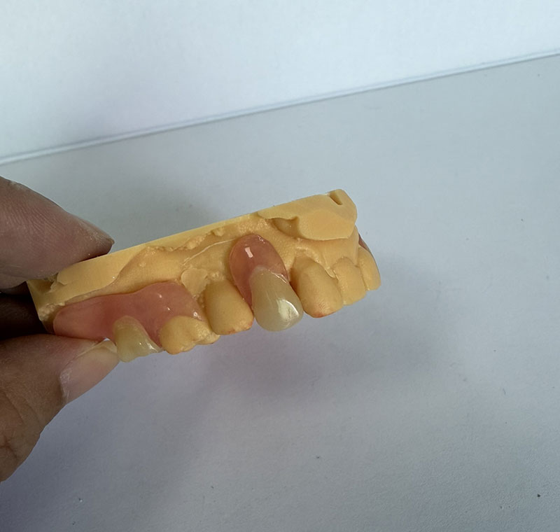 Separa Valplast di WM Dental Lab
