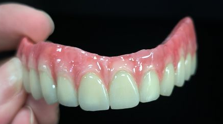 Semua di 4 Hibrid - Jambatan Malo Full Zirconia Mahkota atas Struktur Titanium