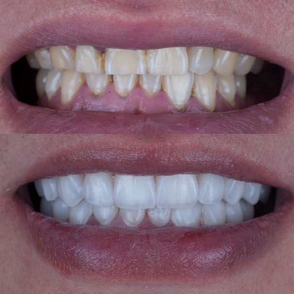 Emax Layered Veneers Esthetic China Dental Lab berfungsi